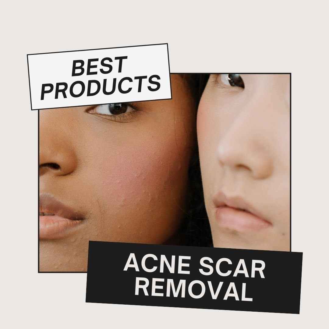 best products for acne scar removal